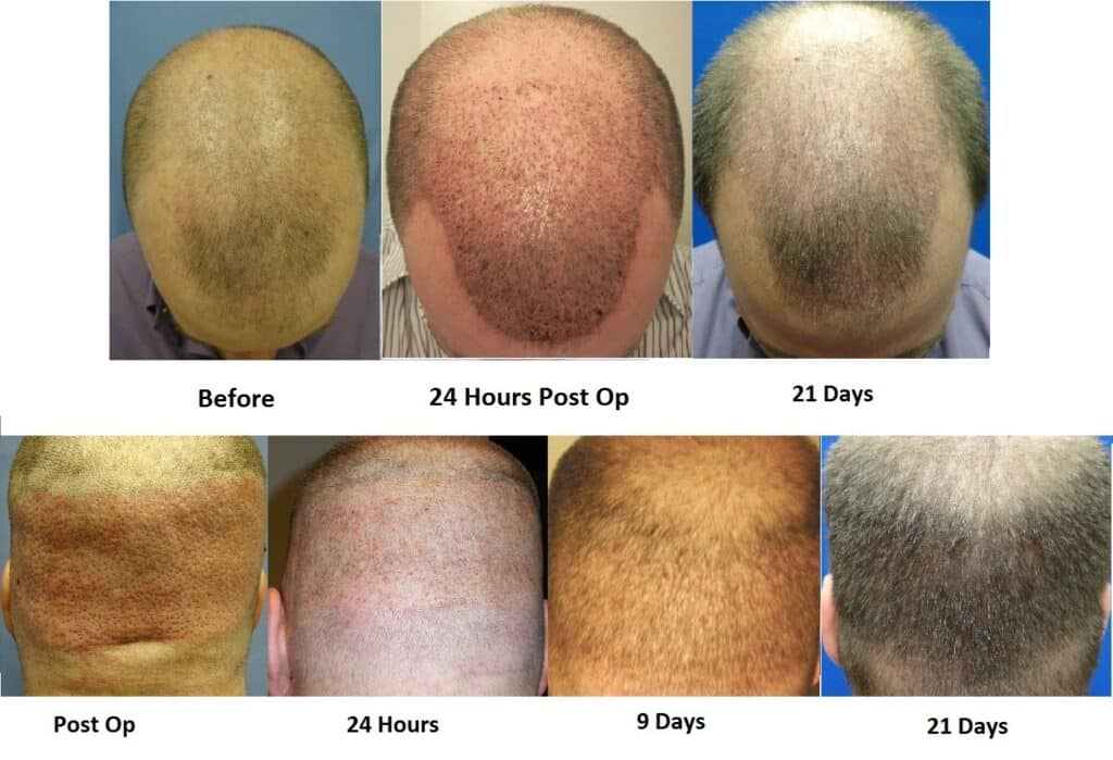 Hair Growth Before and After