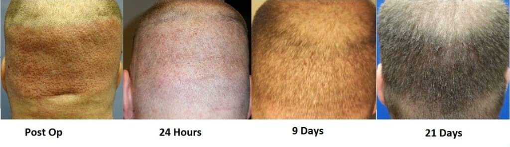 Hair Growth back of head Before and After